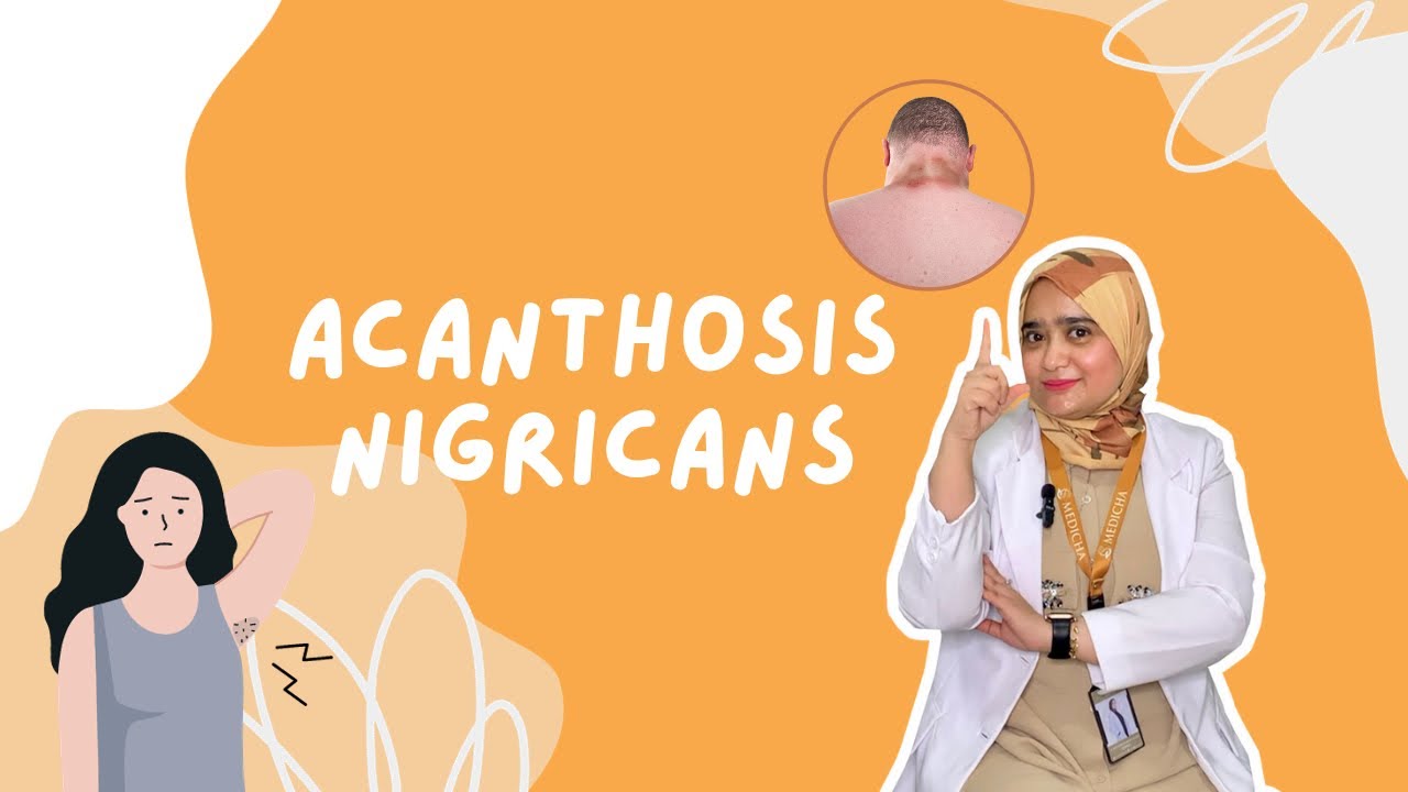 Rahasia di Balik Acanthosis Nigricans: Ketahui Penyebab dan Solusinya untuk Kulit Lebih Sehat