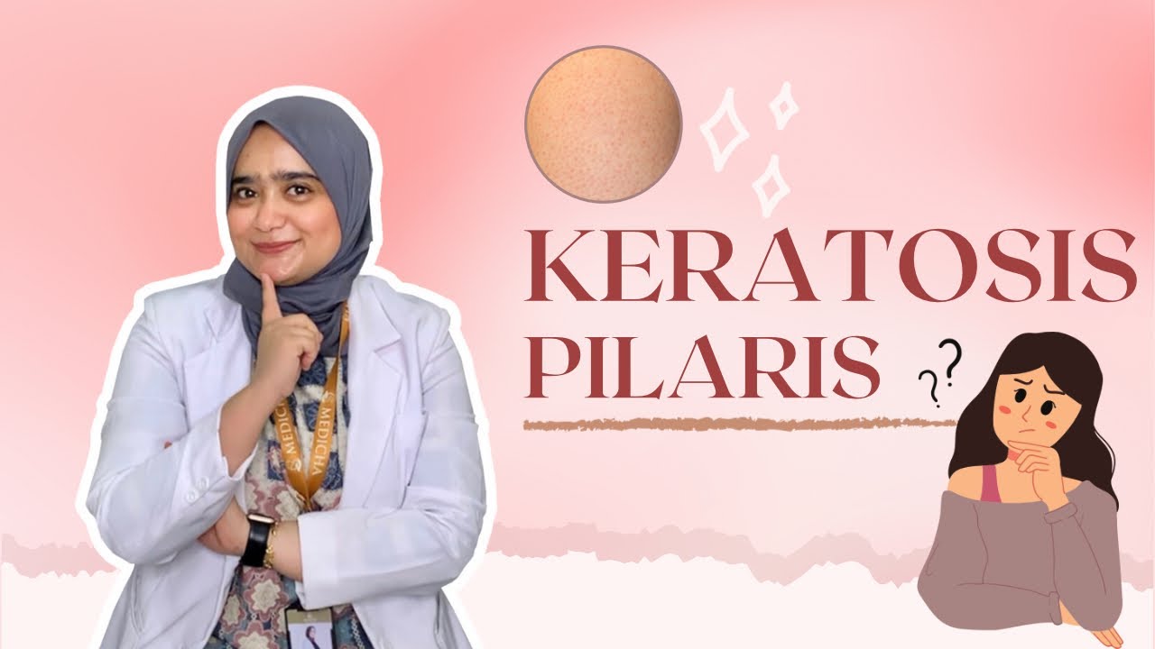 Mengungkap Rahasia Kulit Ayam: Apa Itu Keratosis Pilaris dan Bagaimana Mengatasinya?