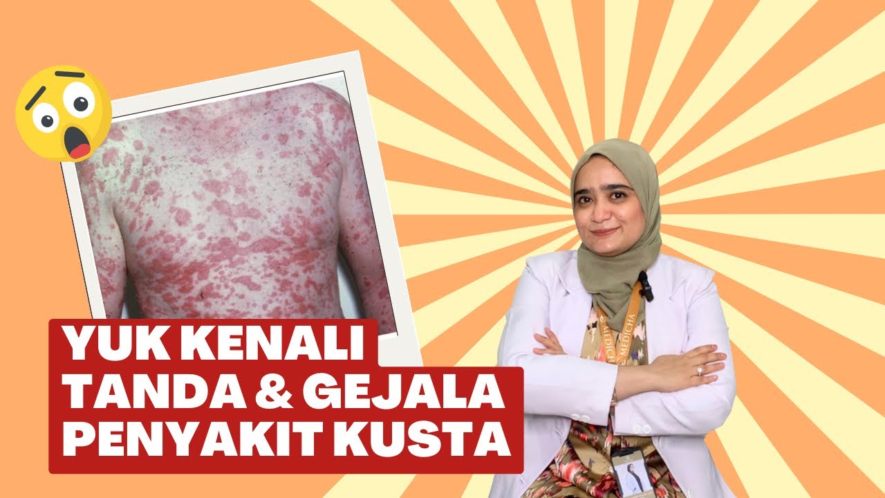 Mengenal Kusta: Fakta Menarik dan Langkah Awal Menuju Kesembuhan yang Sering Terabaikan