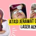 Laser Acne: Solusi Efektif untuk Jerawat dengan Teknologi Canggih