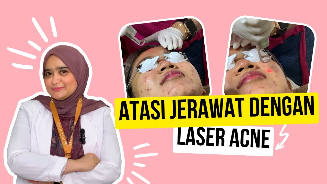 Bergaya Mulus: Mengapa Laser Acne Bisa Menjadi Solusi Ampuh untuk Jerawat Anda!