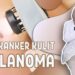 Melanoma: Kanker Kulit Paling Berbahaya, Sejak Dini Deteksi Gejala Utamanya