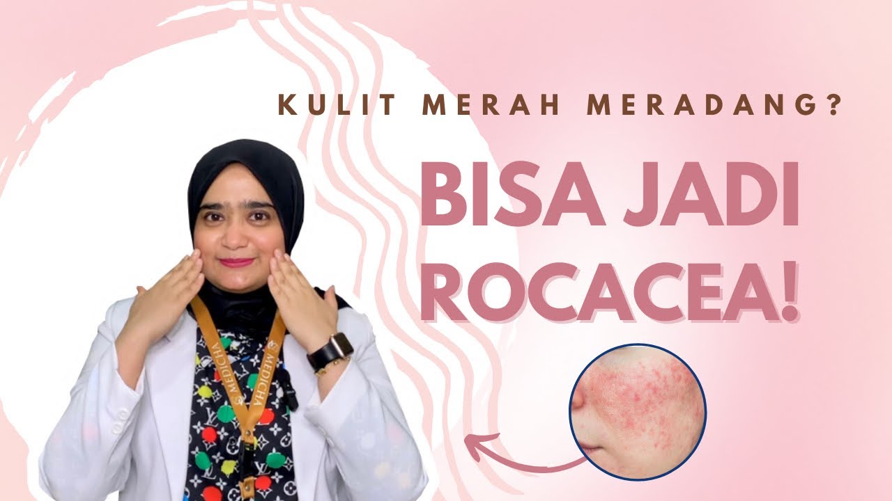Mengenal Tanda dan Penyebab Rosacea: Temukan Solusi untuk Kulit Sehat dan Bersinar!