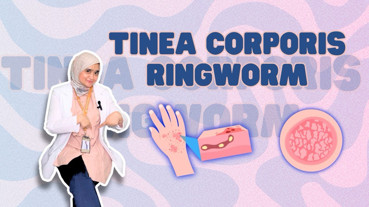 Mengungkap Bahaya Tersembunyi Ringworm: Cara Melindungi Diri dan Keluarga Anda!