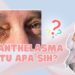 Xanthelasma: Plak Kekuningan di Kelopak Mata; Dampak, Faktor Risiko, & Perawatan