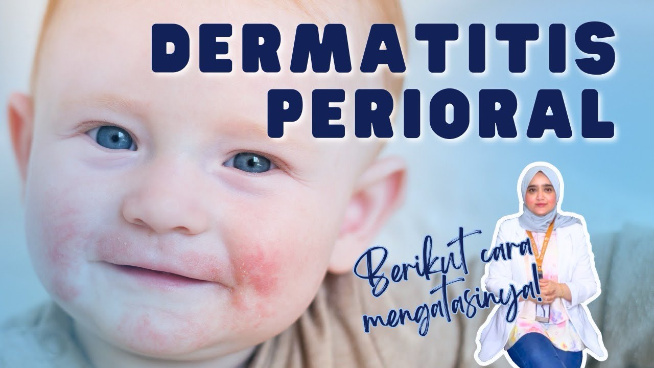 Cara Ampuh Mengatasi Dermatitis Perioral dalam Waktu Singkat: Temukan Solusinya Sekarang!
