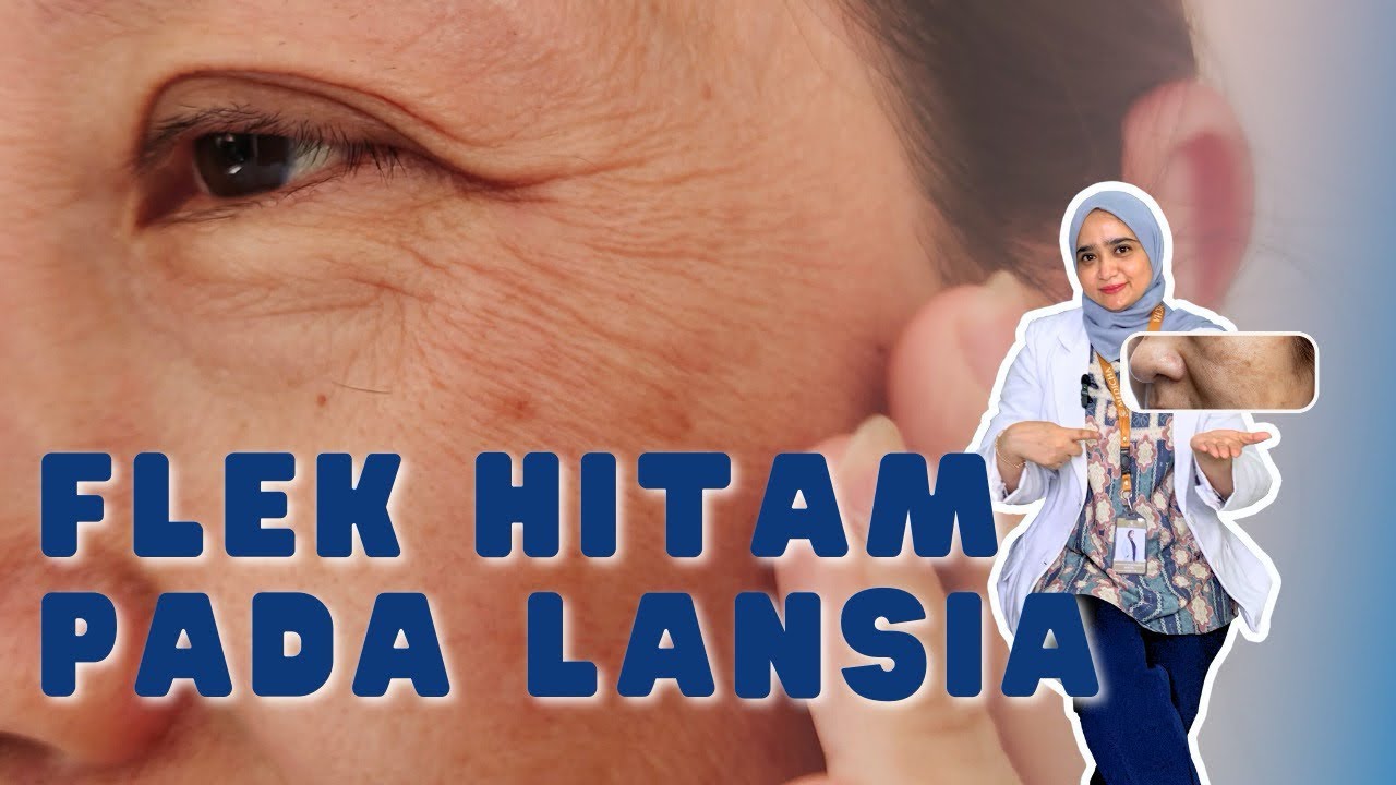 Rahasia Menghilangkan Flek Hitam pada Lansia: Temukan Cara Ampuhnya!