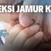 Infeksi Jamur pada Kuku: Masalah dan Penanganannya