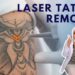 Menghilangkan Tato dengan Laser: Proses dan Keberhasilan')}}