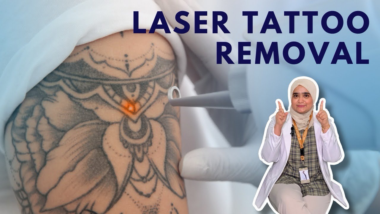 Menghilangkan Tato dengan Laser: Solusi Efektif untuk Memperbarui Kehidupan Anda!