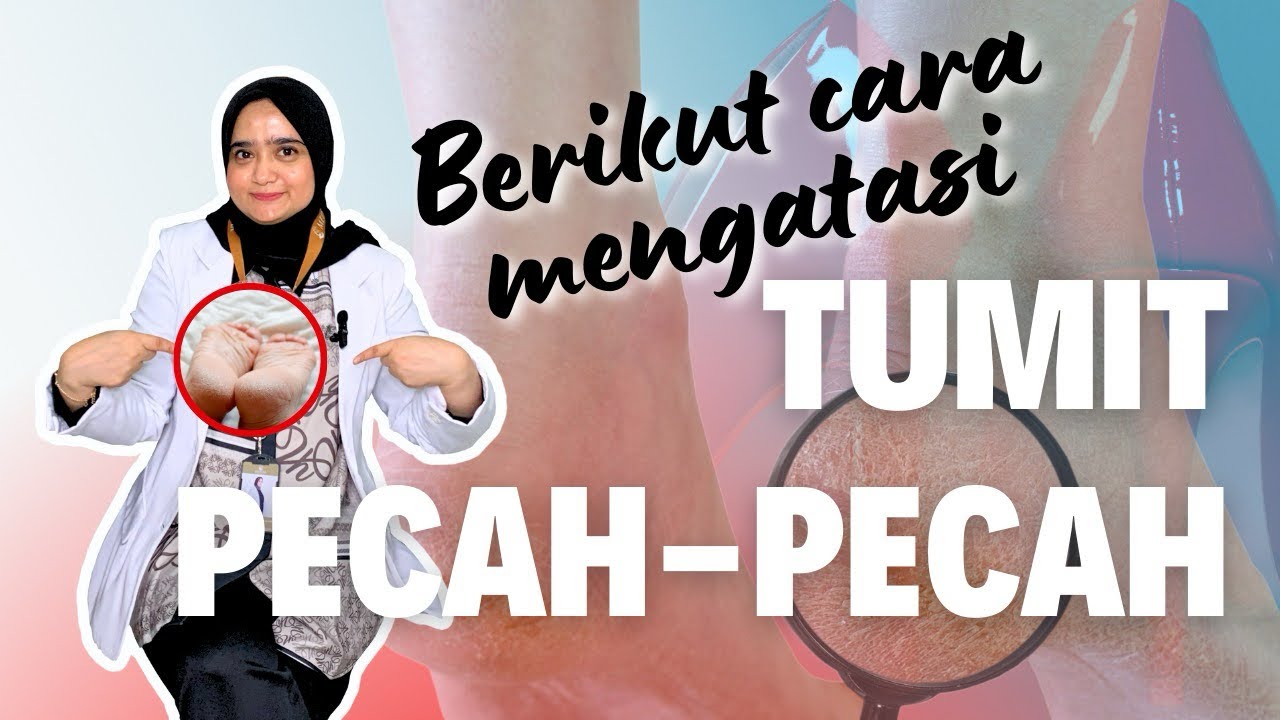 Rahasia Merawat Tumit Pecah-Pecah: Temukan Cara Ampuh untuk Kaki yang Halus dan Sehat!